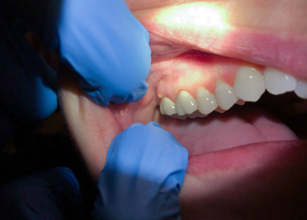 Best Emergency Dental Care for Abscessed Tooth in Crimora, VA