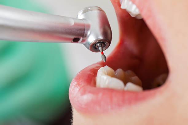 Best Emergency Dentist for Knocked-Out Tooth in Crimora, VA